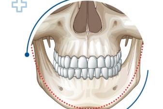  Tạo hình thẩm mỹ phẫu thuật cắt trượt xương hàm trên, xương hàm dưới.