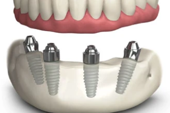  Cấy ghép implant toàn hàm all on4, all on 6