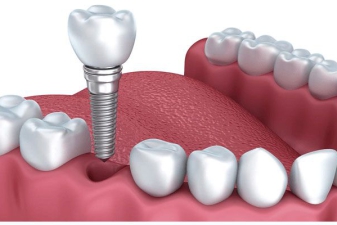 Cắm ghép chân răng nhân tạo Implant